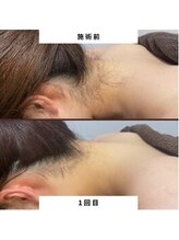 ミース 江坂店/うなじ●ビフォーアフター江坂店