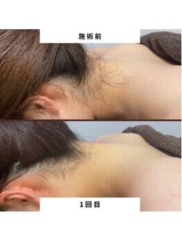 ミース 江坂店/うなじ●ビフォーアフター江坂店