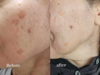 エミナス(EMINAS)/シミ変化