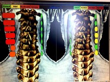 アトラス ストレートカイロプラクティック/頚椎の左右の温度差グラフ画像