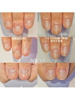 ニコプラス(NICO+)/自爪育成中