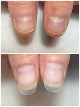 スマイルニコ(smile nico)/長さ出しの中に自爪が伸びている