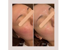 アウラ 砺波店(AULA)の雰囲気(【水光肌♪】韓国発のピーリング♪女性にも男性にもおススメ☆)