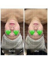 トニック バイ まつもと整骨院鍼灸院(Tonic)/★RF小顔のBefore After★