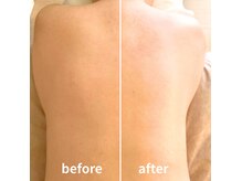 ◆むくみ・老廃物にアプローチ！一回のドレナージュbefore/after