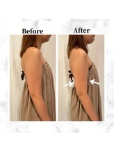 ザビューティー 麻布十番本店(The Beauty)/二の腕リフト打ち放題[リフト]