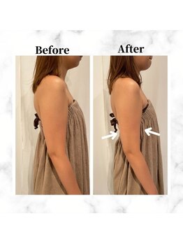 ザビューティー 麻布十番本店(The Beauty)/二の腕リフト打ち放題[リフト]