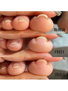 リエル(Riel)/巻き爪ケア　親指2本￥5500