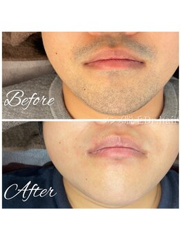 ドクターヘア 徳島店(Dr.hair)/モニター様の症例画像です(正面)