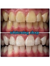 ホワイトニングショップ 天王寺店/40分照射×10回 30代女性