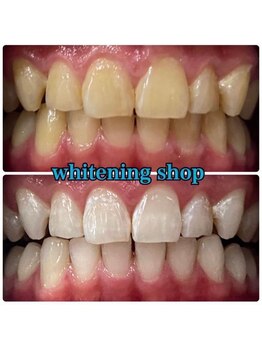 ホワイトニングショップ 天王寺店/40分照射×10回 30代女性