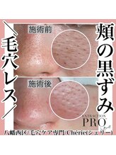 シェリー(Cherie)/頬・眉間・顎の汚れも取ります