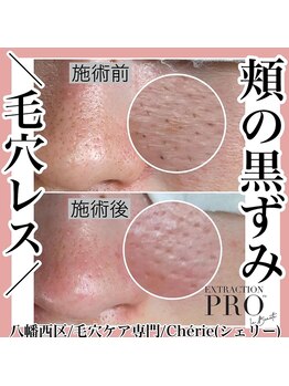 シェリー(Cherie)/頬・眉間・顎の汚れも取ります