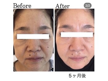 エラフリー/年齢肌でお悩みの方にもお勧め☆