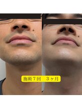 アールブイ 館林店(RV)/ヒゲ脱毛BeforeAfter