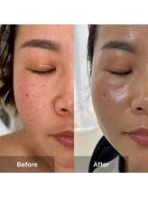 サロン ド アヤ(salon de Aya)/一回施術で肌乾燥の改善