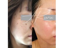 アルル 甲賀(ARuru)