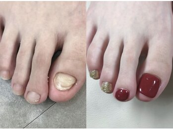 ティアラネイル 宇都宮/深爪矯正