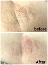 エクラニーク(Eclanique)/シュガーリング脱毛　脇