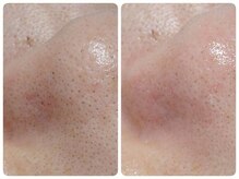 トータルビューティ ノイド(Noid)/いちご鼻　撃退コース