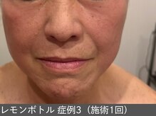 オアシスラグーン(OASIS LAGOON)/レモンボトル（症例3 施術1回）