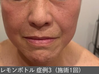 オアシスラグーン(OASIS LAGOON)/レモンボトル(症例3 施術1回)
