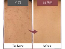 フルリール/【背中トリートメント】