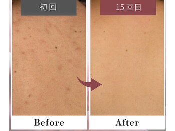 フルリール/【背中トリートメント】