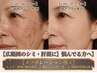 【もやもやシミ】他店でダメだった方！まぶたOKかんぱん乾燥改善に特別ケア
