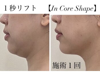リアン 南熊本店(Lien)の写真/【たった1回で顔が変わる！】渡韓しなくてもOK！韓国発“1秒リフト”九州初！【本格マイクロ波リフト】