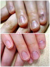 アンプティボヌール(Un P'tit Bonheur)/噛み爪