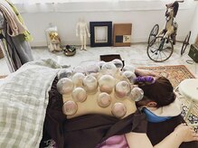 トナリ鍼灸院/【背中のこり、疲れ】吸玉