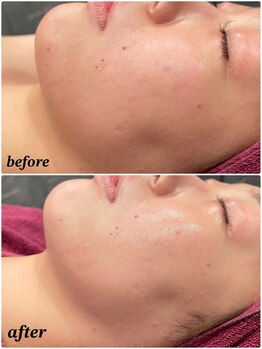 ソルエユニーク(Le seul et unique)/フェイスラインスッキリ★