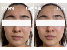 ウールー(Heureux)/一回の施術で仰天小顔！！！