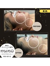 ミノ 美里大通り店(mino)/どんな肌質でも改善策あります☆