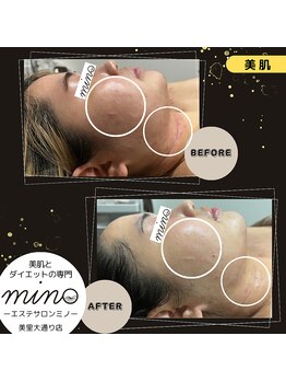 ミノ 美里大通り店(mino)/どんな肌質でも改善策あります☆