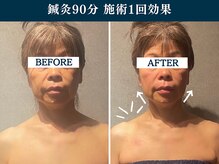 シンク(CINQ)/お顔を触れずにリフトアップ