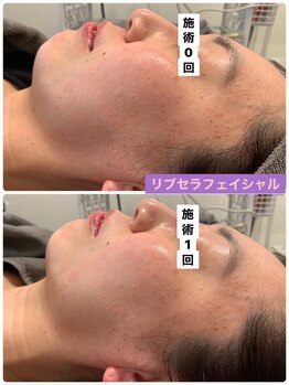 プリュネル(Prunelle)/プラズマシャワー