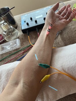ライズ/腕への電気鍼とお灸