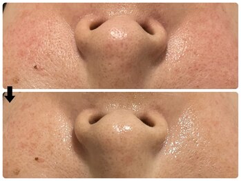 エフェクト 塚口店(effect)/Before After 40代/1回目