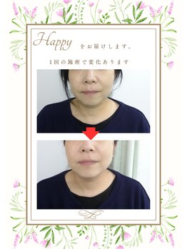 ビードット(B.)/フェイシャル施術1回目