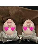 トニック バイ まつもと整骨院鍼灸院(Tonic)/★Before After★豊中／毛穴