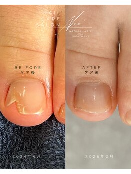 フットシンプルケア+補強