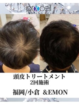 アンドエモン(&EMON)/【頭皮】プロセル効果