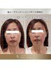 【たるみ×小顔矯正】頭蓋骨小顔矯正で若見え小顔コース90分¥12000→¥8400