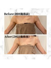 ザビューティー 麻布十番本店(The Beauty)/二の腕リフト打ち放題[リフト]