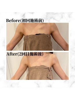 ザビューティー 麻布十番本店(The Beauty)/二の腕リフト打ち放題[リフト]