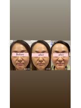 アリウム(Allium)/痩身機械で小顔へ