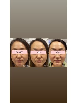 アリウム(Allium)/痩身機械で小顔へ