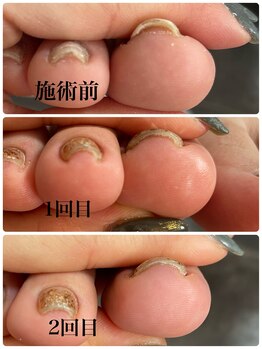 リエル(Riel)/巻き爪ケア　親指2本￥5500